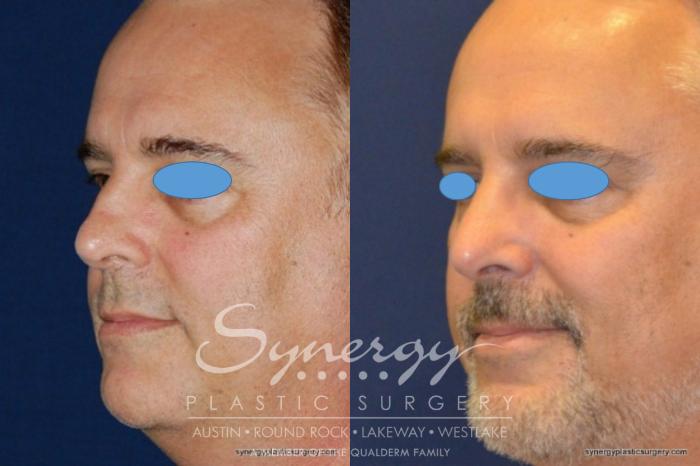 Before & After  Case 209 View #3 View in Austin, TX