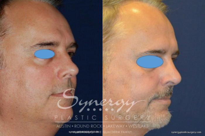 Before & After  Case 209 View #4 View in Austin, TX