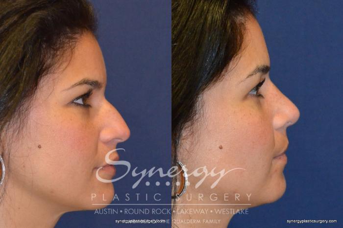 Before & After  Case 227 View #1 View in Austin, TX