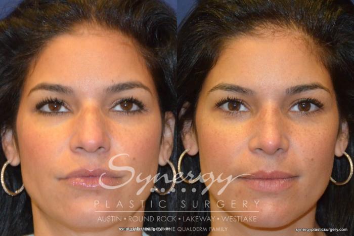 Before & After  Case 227 View #2 View in Austin, TX