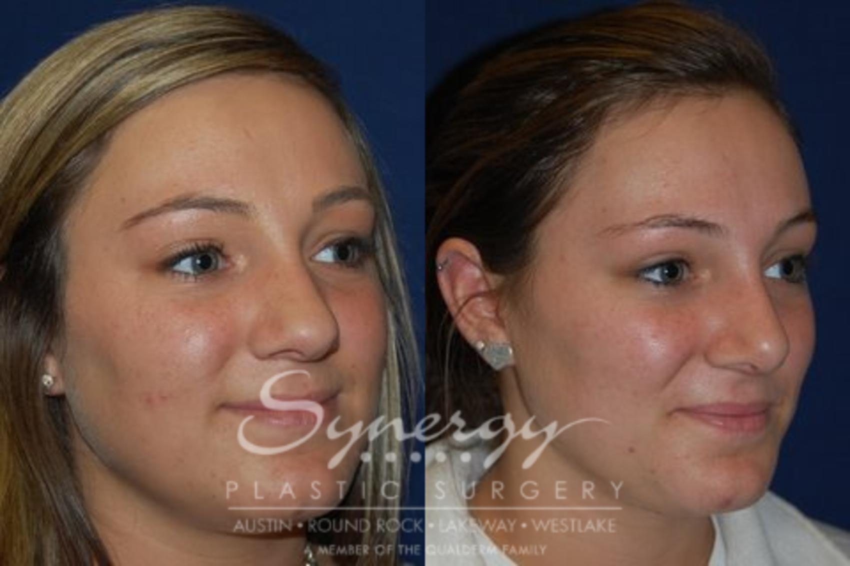 Before & After  Case 44 View #1 View in Austin, TX