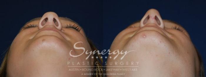 Before & After  Case 44 View #5 View in Austin, TX