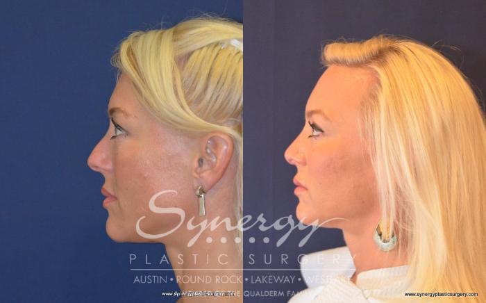 Before & After Rhinoplasty Case 488 View #1 View in Austin, TX
