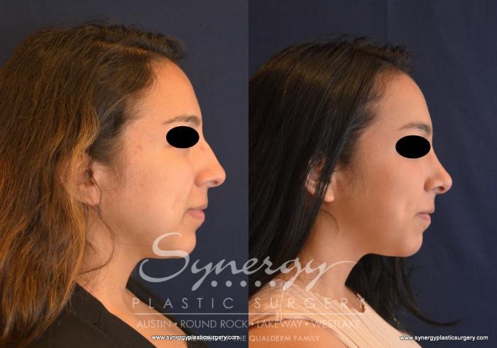 Before & After Rhinoplasty Case 624 View #3 View in Austin, TX