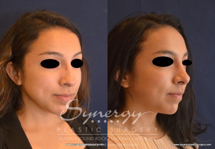 Before & After Rhinoplasty Case 624 View #4 View in Austin, TX