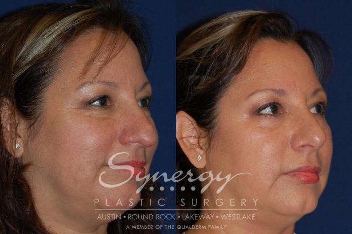 Before & After Rhinoplasty Case 89 View #2 View in Austin, TX