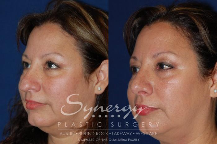 Before & After Rhinoplasty Case 89 View #3 View in Austin, TX