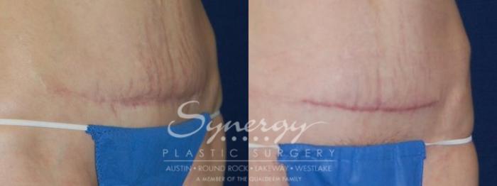 Before & After  Case 51 View #3 View in Austin, TX