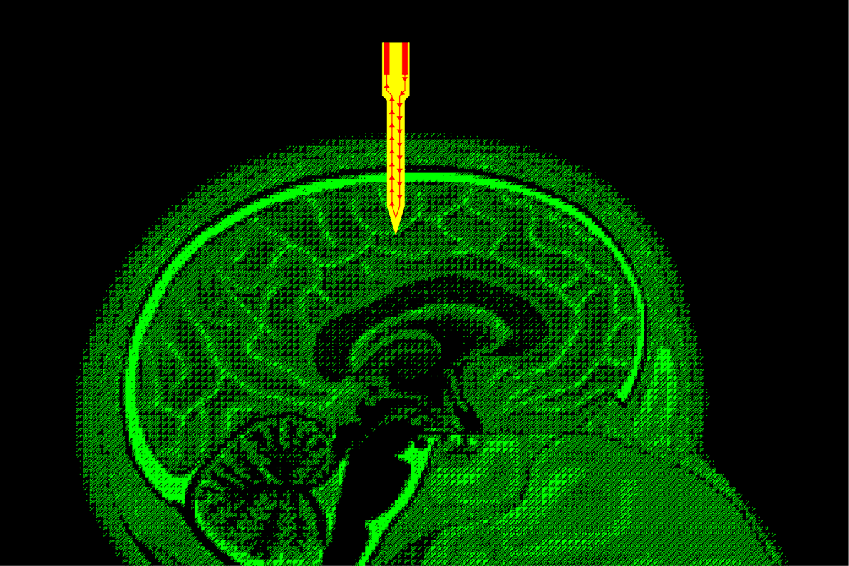 Brain stimulation