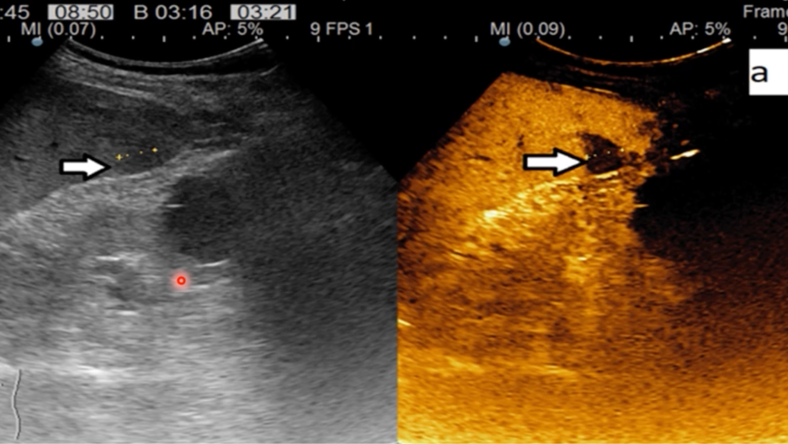 ULTRASONOGRAFIA CU CONTRAST - DE LA TEORIE LA PRACTICĂ