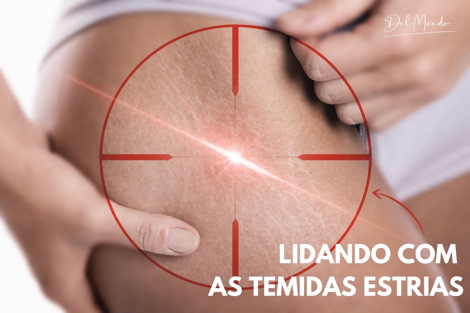 Lidando com a temidas estrias