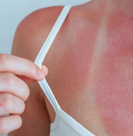 Imagem do post Pós-sol: como tratar a vermelhidão e evitar manchas