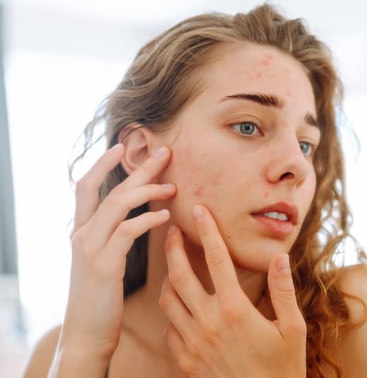 Imagem do post Saiba como manter a pele sem acne no verão