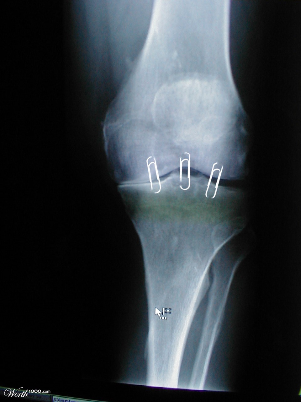 broken leg