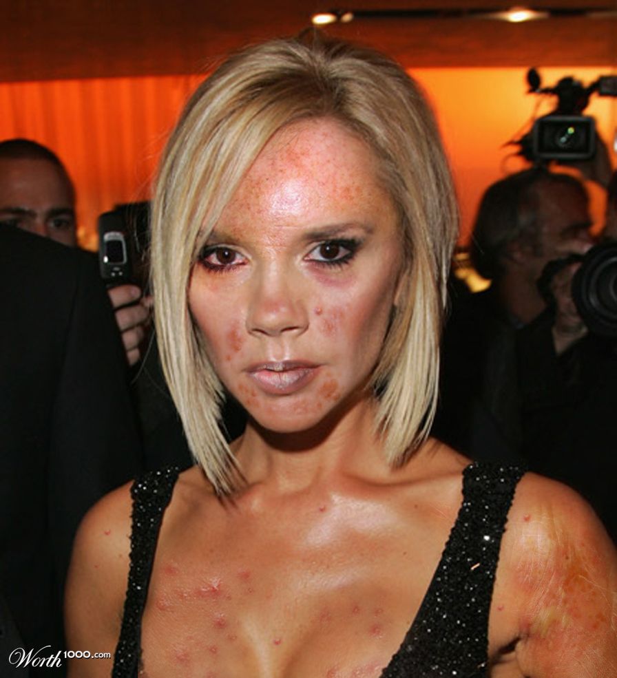 skin disease