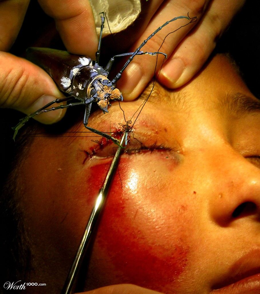 Suturing
