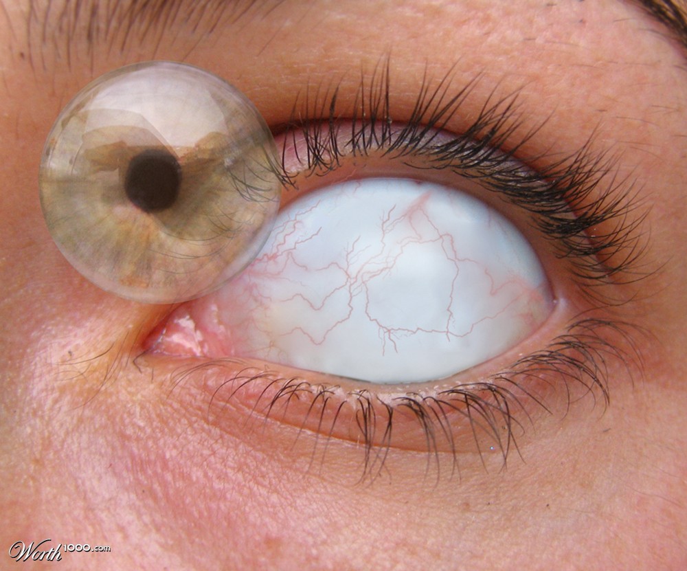 Bubble eye
