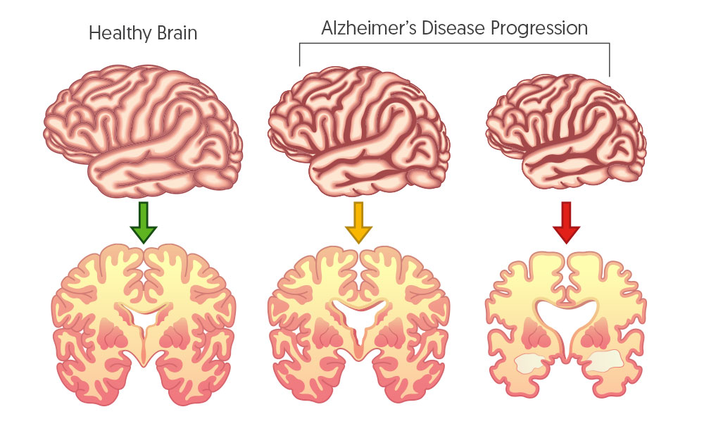 Alzheimer's Disease Progression