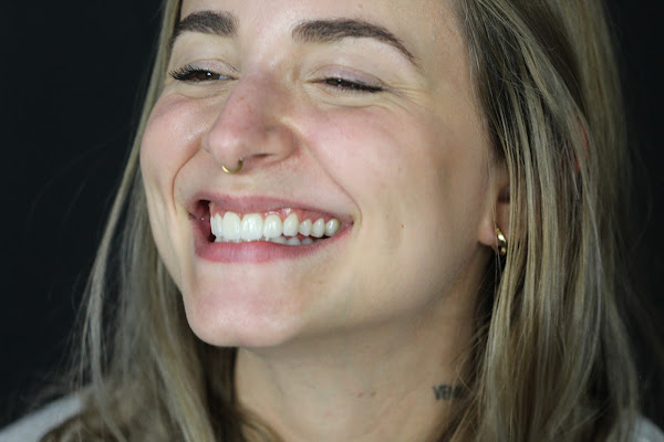 SB Odontologia Especializada - 40 anos - Dentista Pompéia - Dentista Perdizes- Implantes - Estética Dental - Facetas - Lente de Contato Dentais - Próteses - Botox - Cirurgia - Endodontia - Ortodontia Invisalign