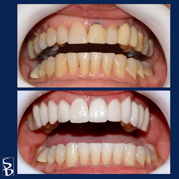 Foto 1 SB Odontologia Especializada - 40 anos - Dentista Pompéia - Dentista Perdizes- Implantes - Estética Dental - Facetas - Lente de Contato Dentais - Próteses - Botox - Cirurgia - Endodontia - Ortodontia Invisalign