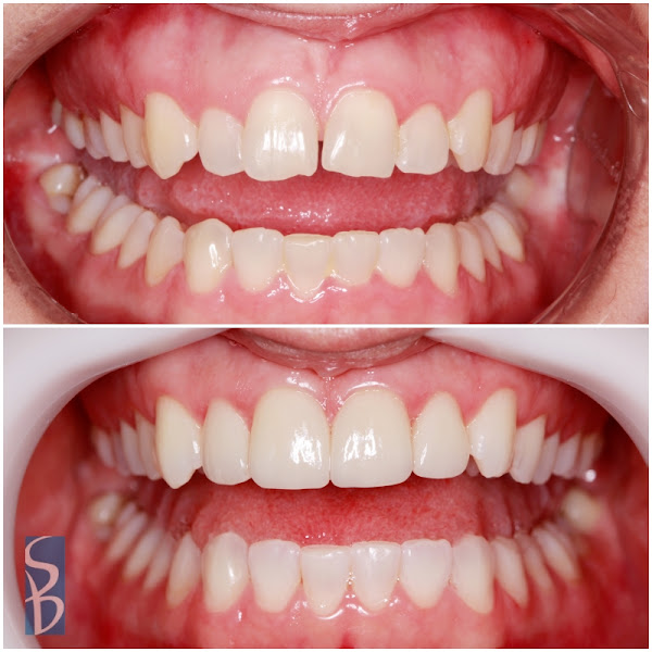 Foto 5 SB Odontologia Especializada - 40 anos - Dentista Pompéia - Dentista Perdizes- Implantes - Estética Dental - Facetas - Lente de Contato Dentais - Próteses - Botox - Cirurgia - Endodontia - Ortodontia Invisalign