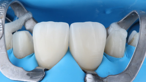 Foto 0 Dr Renato Sartori Dentista Faria Lima Itaim Bibi - Lentes de Contato Dentais