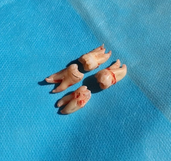 Foto 1 Dr Renato Sartori Dentista Faria Lima Itaim Bibi - Lentes de Contato Dentais