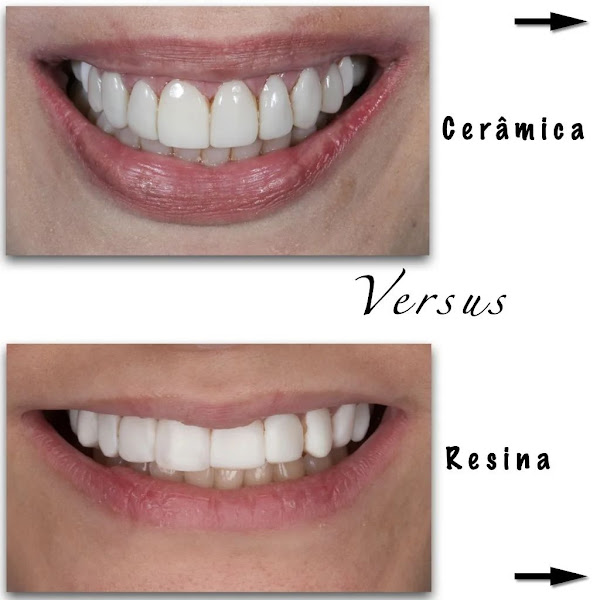 Foto 4 Dr Renato Sartori Dentista Faria Lima Itaim Bibi - Lentes de Contato Dentais