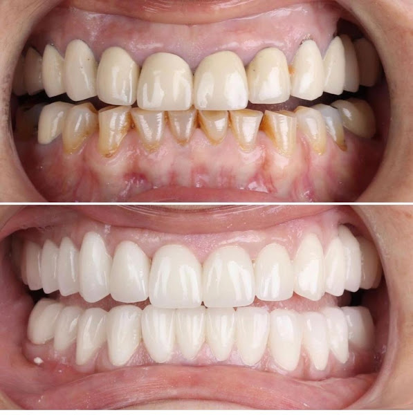 Dentistas na Lapa - Dra. Márcia S. Borges - Especializada em implantes e restaurações.