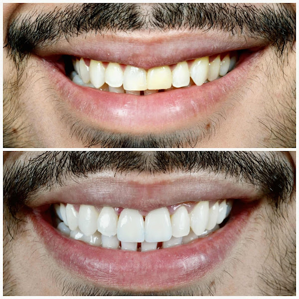 Foto 1 Clínica Odontoliuzzi - Facetas de Porcelana - Implante Dentário - Ortodontia - Periodontia - Dentística - Prótese Protocolo - Endodontia