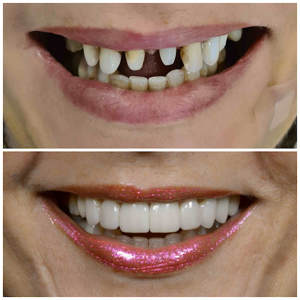 Foto 3 Clínica Odontoliuzzi - Facetas de Porcelana - Implante Dentário - Ortodontia - Periodontia - Dentística - Prótese Protocolo - Endodontia