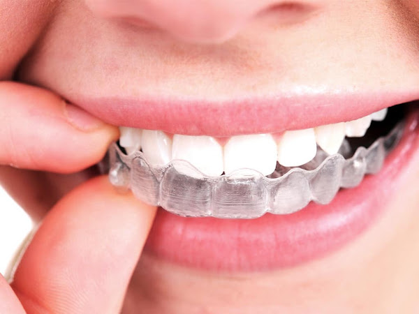 Dra. Bruna Martins / Invisalign, Aparelho Lingual, Aparelho Invisível
