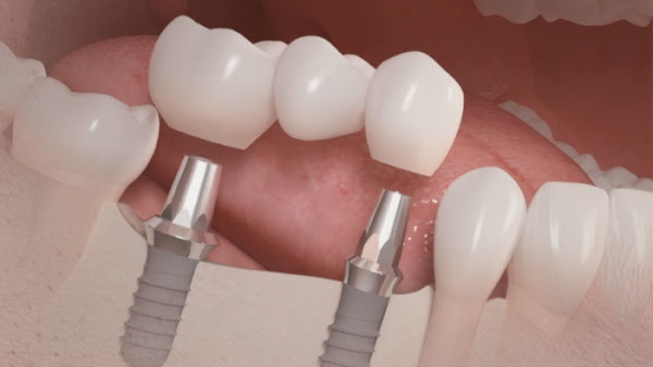 ImplantEXS - Eduardo Xavier - Dentista ImplantEXS - Eduardo Xavier - Dentista