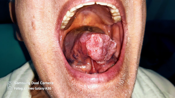 ESTOMATOLOGISTA Doenças da Boca Dr Alexandre Giannini ESTOMATOLOGISTA Doenças da Boca Dr Alexandre Giannini