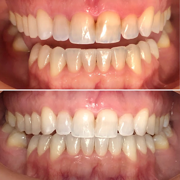Foto 5 Inspiratto Odontologia: Invisalign, Clareamento Dental, Lentes de Contato Dentais, Harmonização Facial, Ortodontia, Brasília DF