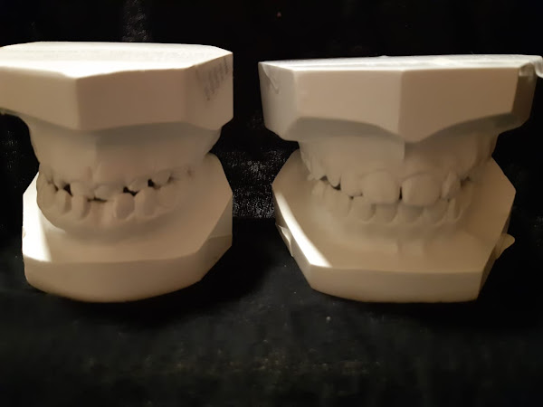 Foto 1 Ronco e Apneia do Sono - Dra.Norma Melucci - Tratamentos