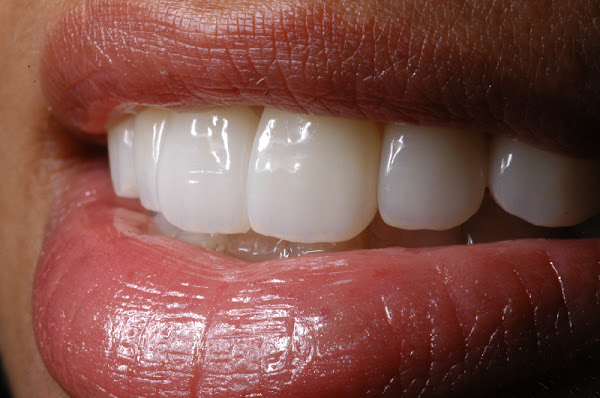 Rafael LUNARDI - Odontologia Estética Restauradora e Reabilitação Oral