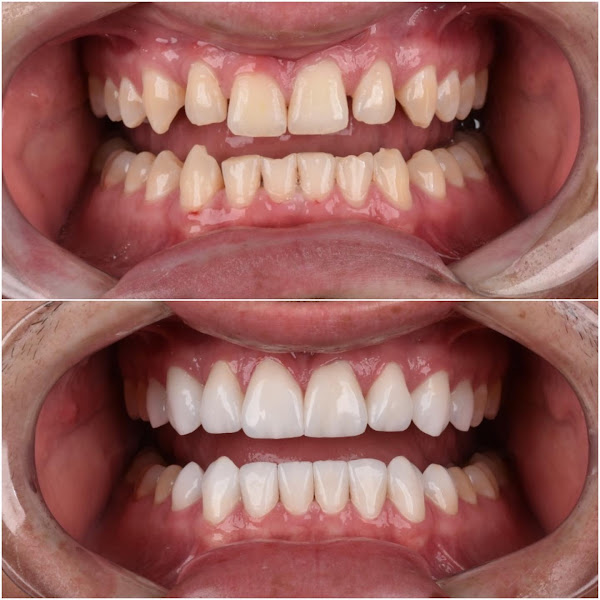 Foto 2 Implante Ingá