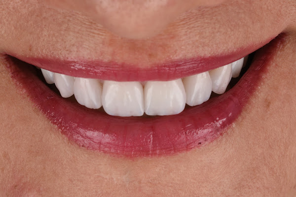 Foto 4 Implante Ingá