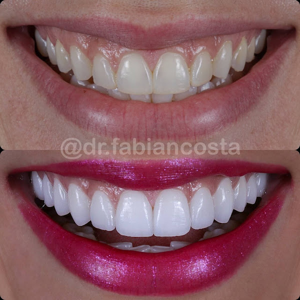 Lentes de Contato Dental - Dr. Fabian Costa Lentes de Contato Dental - Dr. Fabian Costa