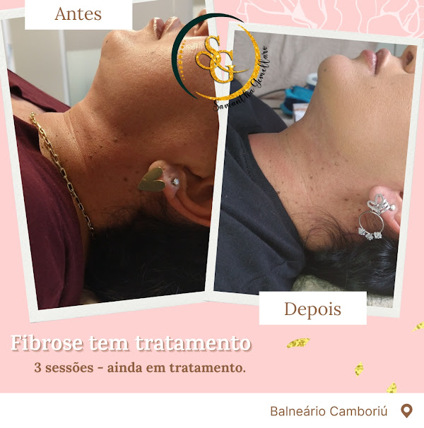 Foto 2 Pós Operatório - Samantha Gemellaro