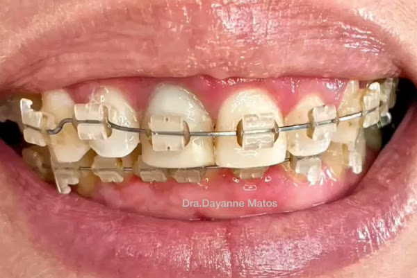 Foto 1 Dra. Dayanne Matos - Invisalign em Bacabal