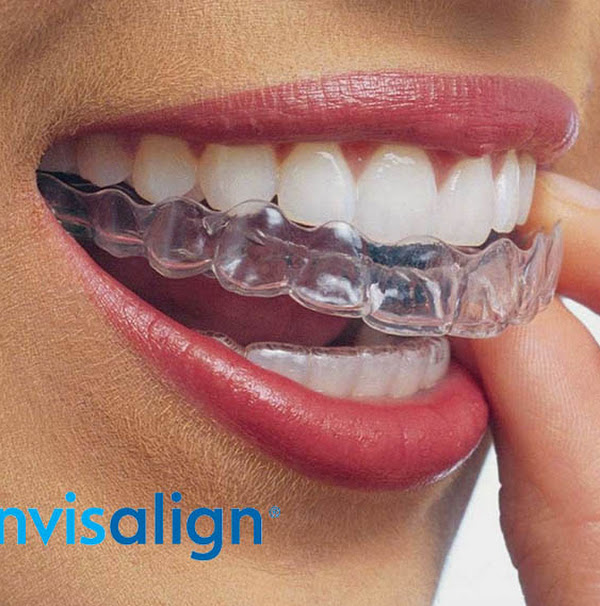 Foto 3 Dra. Dayanne Matos - Invisalign em Bacabal Foto 3 Dra. Dayanne Matos - Invisalign em Bacabal